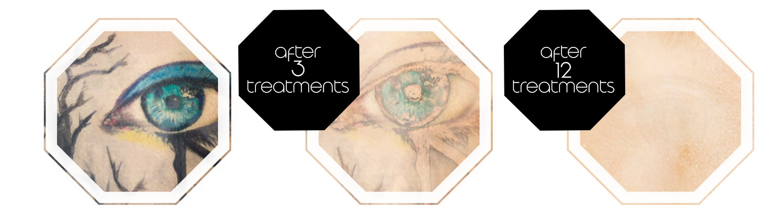 Treatment sucess tattoremoval foto progression
